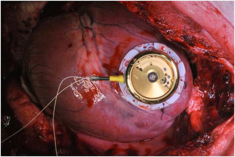 Nella foto, il pacemaker che sfrutta il meccanismo dell'orologio automatico