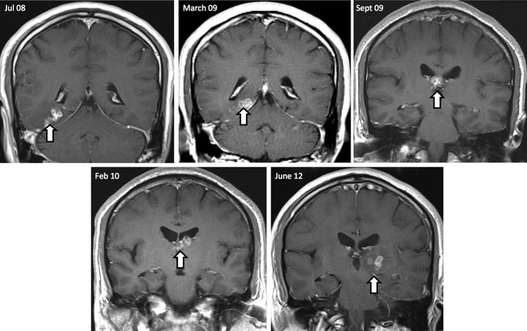 Nella foto, i movimenti del parassita, nel corso degli anni, all'interno del cervello del paziente