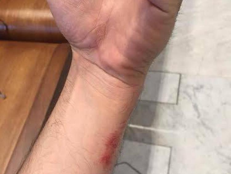 Il braccio infortunato di Alessandro Onorato in una foto postata su Facebook 