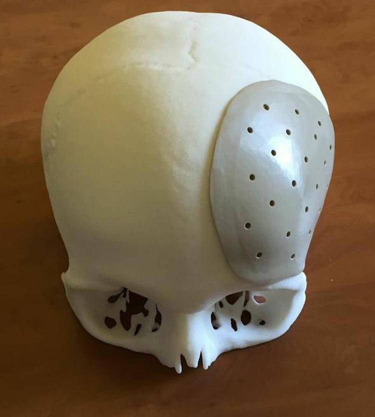 Protesi 3D scatola cranica - Asl 2 Abruzzo 