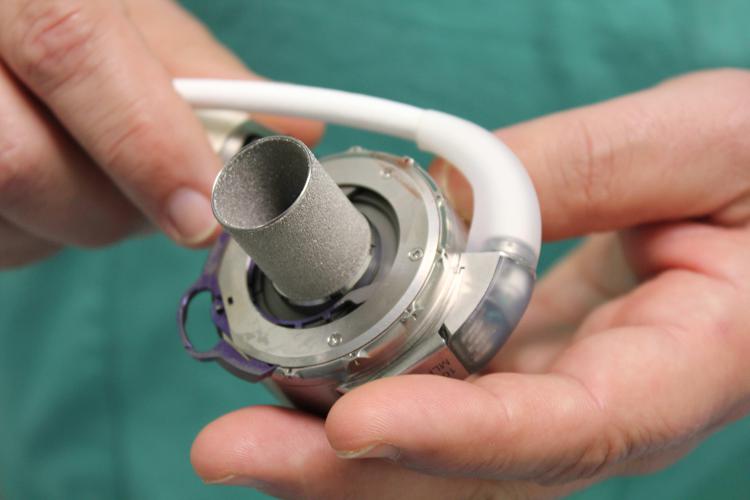 'Heart Mate 3', il nuovo cuore artificiale magnetico impiantato per la prima volta in una paziente pediatrica al Bambino Gesù di Roma