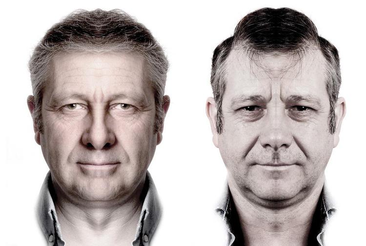 Il lato sinistro e il lato destro del viso di Jim sono differenti. Ecco come apparirebbero se le due metà fossero perfettamente simmetriche. Tutte le immagini sono ricostruzioni di volti con emiparesi di David Blackwell (Flickr)