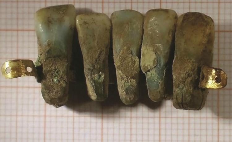 La protesi dentale trovata nella tomba, foto dell'Università di Pisa 
