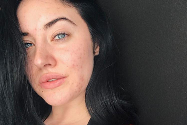 La modella con l'acne conquista Instagram