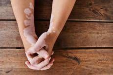 Estate, vitiligine e sole: le regole per una abbronzatura sicura