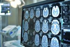 Telemedicina, progetto telestroke permette di trattare ictus a distanza