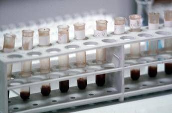 Colesterolo alto 'di famiglia', nuovo test genetico predice i rischi Colesterolo alto 'di famiglia', nuovo test genetico predice i rischi