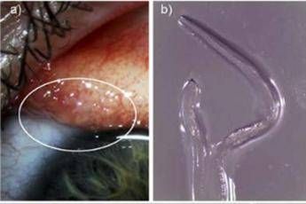 Le brucia un occhio, dentro ci sono 14 vermi Le brucia un occhio, dentro ci sono 14 vermi