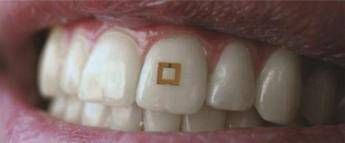 Cosa mangi? Te lo dice un sensore sul dente Cosa mangi? Te lo dice un sensore sul dente