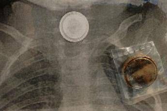 Ingoia batteria 'killer', salvo bimbo di 4 anni Ingoia batteria 'killer', salvo bimbo di 4 anni