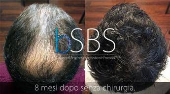 Insulina arma anti-calvizie, rigenera i follicoli Insulina arma anti-calvizie, rigenera i follicoli
