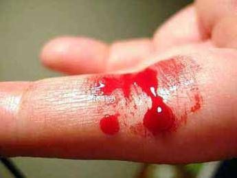 Emofilia A, sanguinamenti ridotti con farmaco Roche Emofilia A, sanguinamenti ridotti con farmaco Roche