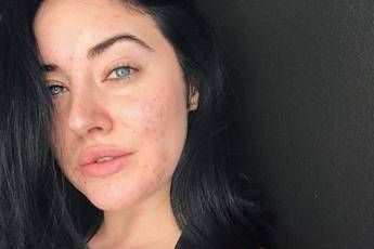 La modella con l'acne conquista Instagram La modella con l'acne conquista Instagram
