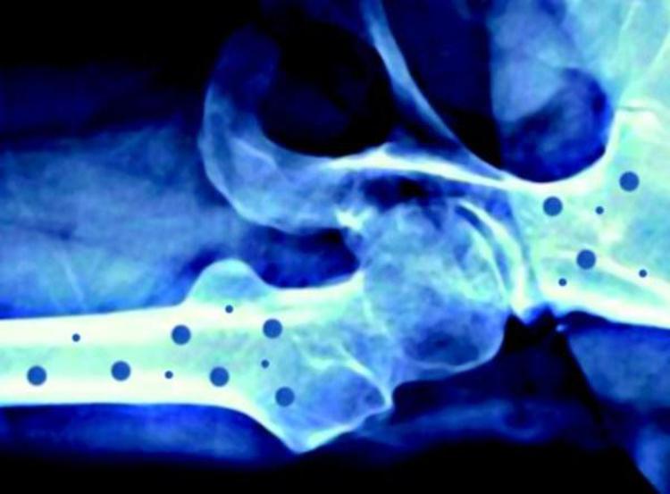 Medicina: ossa fragili, ecco il decalogo anti-frattura