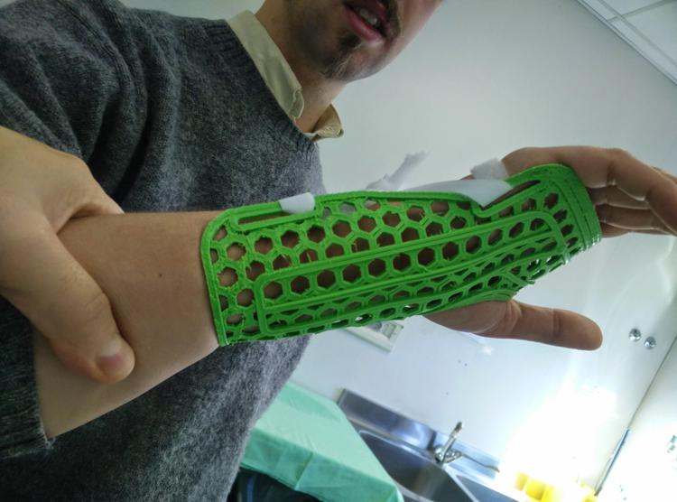 Tutore stampato in 3D - Istituto ortopedico Rizzoli 