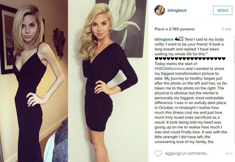 Haley Harris prima e dopo la vittoria sull'anoressia (fonte Instagram /#BitingBack)