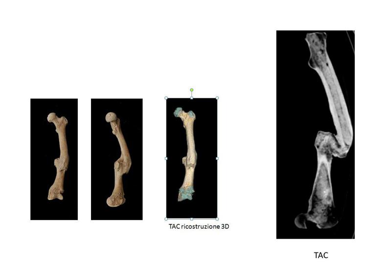 Frattura del femore - Bones: Orthopaedic Pathologies in Roman Imperial Age (Springer ed)