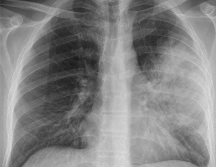 Tumori: 110 nuove diagnosi di cancro al polmone al giorno in Italia
