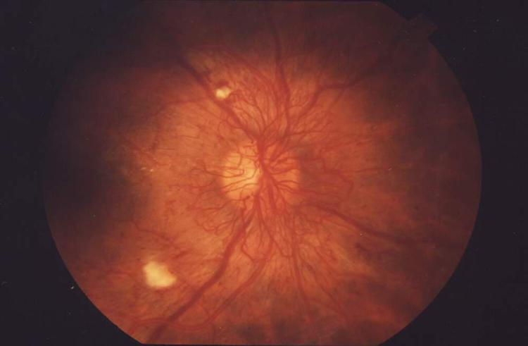 Sanità: 1 mln con retinopatia diabetica, rischio spesa +4,2 mld in 15 anni