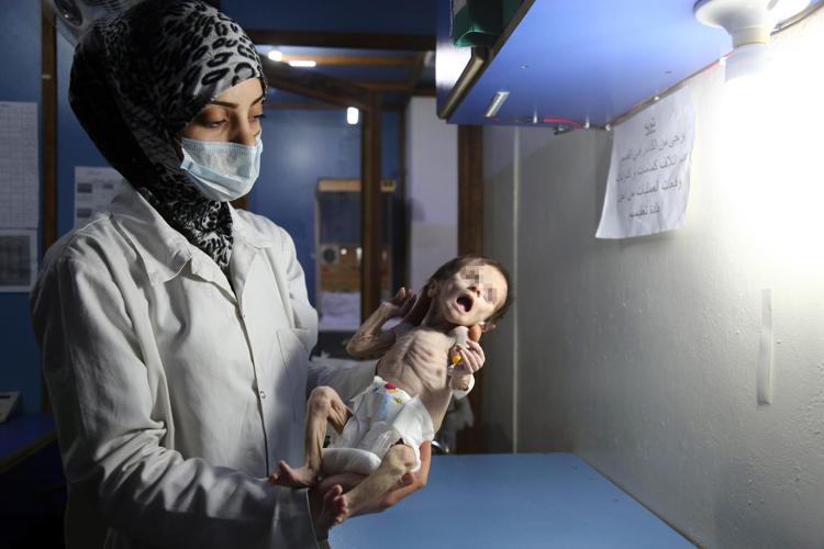 La bimba siriana Sahar tra le braccia di un'infermiera (AFP PHOTO/ Amer Almohibany)