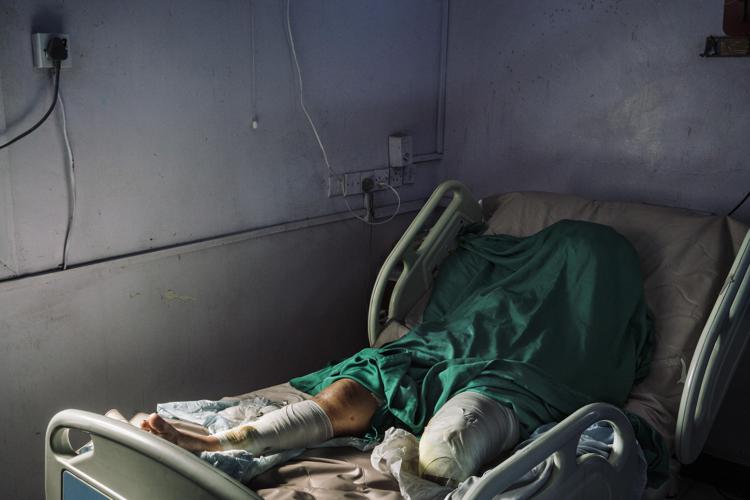 Wafa Ahmed Hathim, 25, lost her left leg when a mortar landed on her home in  Yemen's port city of Hodeida.Photo for The Washington Post by Lorenzo Tugnoli.