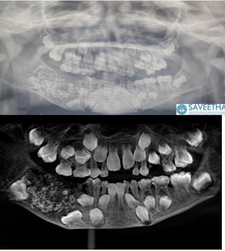 Le radiografie della dentatura  - Saveetha Dental College and Hospital