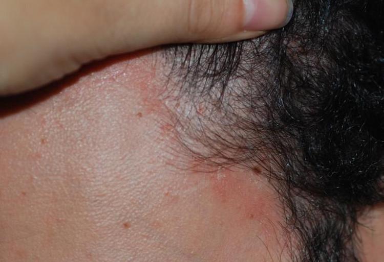 Mascherine per il Covid-19: come evitare che la dermatite seborroica si aggravi