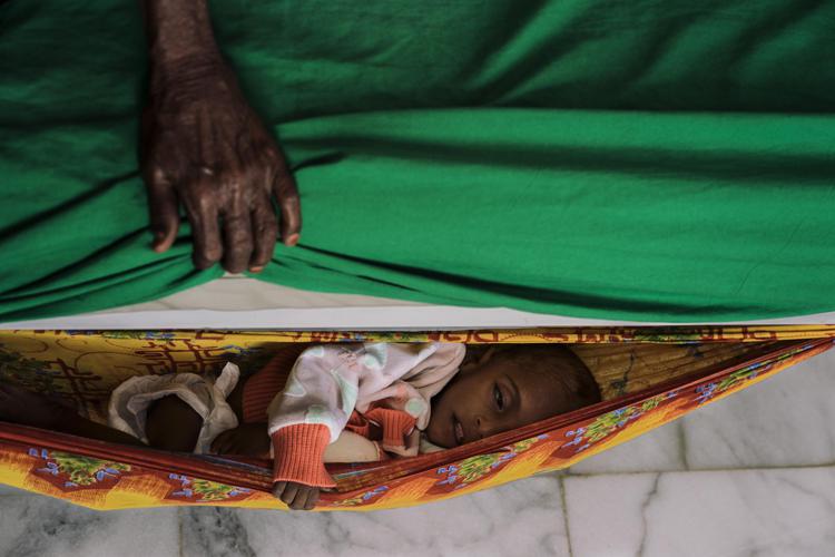  A severely malnourished child in YemenPhoto: Lorenzo Tugnoli/ Washington Post 