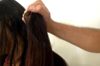 Alopecia per 4 mln donne, dermatologi in prima linea con terapie innovative