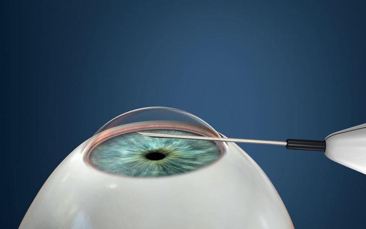 Glaucoma, nuova tecnica chirurgica con strumento record: meno di 1 millimetro