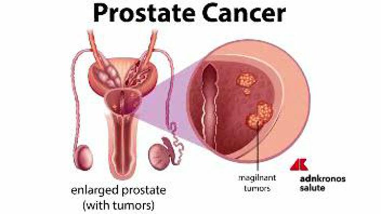 simptomele și tratamentul adenomului de prostată mydocalm pentru dozarea prostatitei