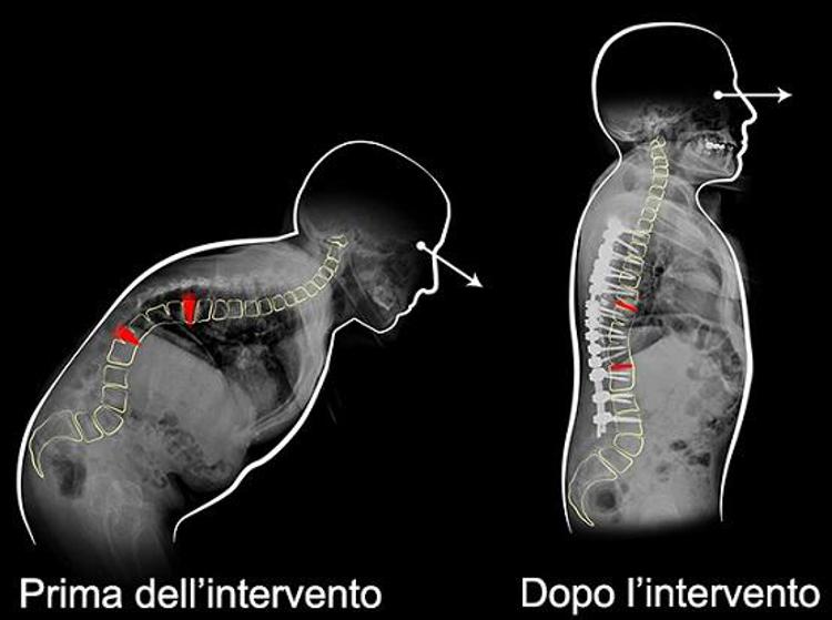 Operazione record su schiena: tolte 2 vertebre, paziente torna a camminare