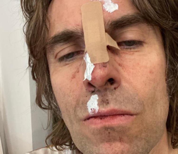 Liam Gallagher cade dall'elicottero e si ferisce