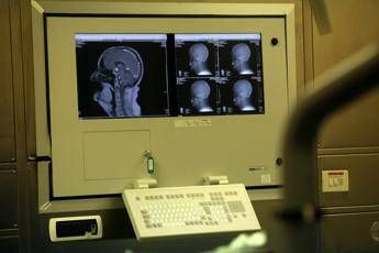 “70-80% ictus evitabile con adeguati stili di vita”