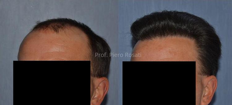 Il trapianto di capelli: un effetto più folto con la metodica CFU