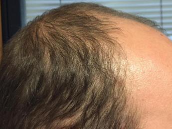 Covid, 1 in 3 hair loss after infection