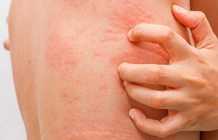 Fake news sull'orticaria, l'immunologo: 