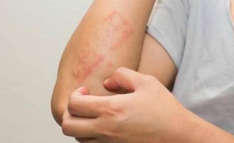 Dermatologo Bardazzi, 'facilitare diagnosi psoriasi con la regola del 10'