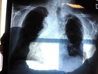 The survey, 67% of Italians do not know what lung cancer is