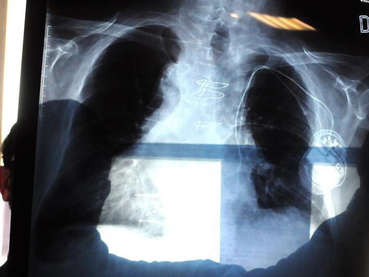 Una tac ai polmoni - Fotogramma