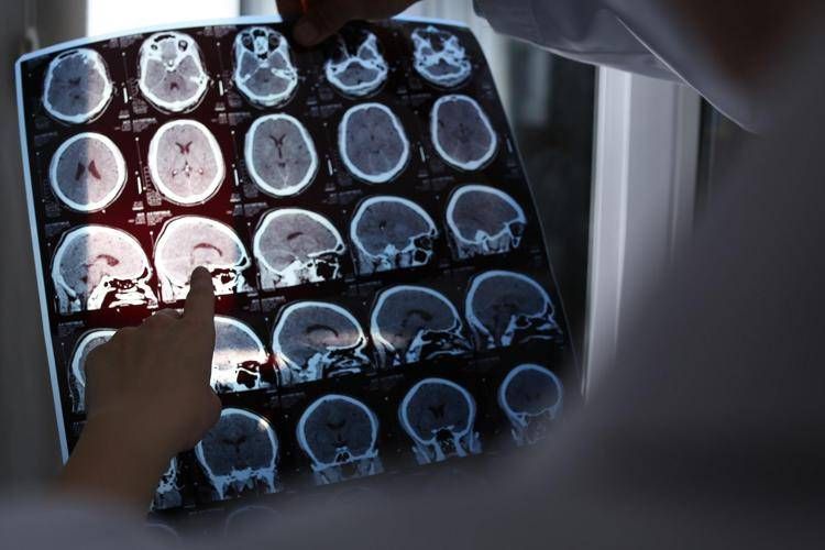 Giornata mondiale dell'Alzheimer - 123RF