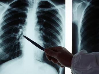 “Tuberculosis on the rise, it’s scary again”