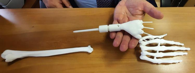 Gemelli Roma, polso stampato in 3D salva mano destra di una neo-mamma