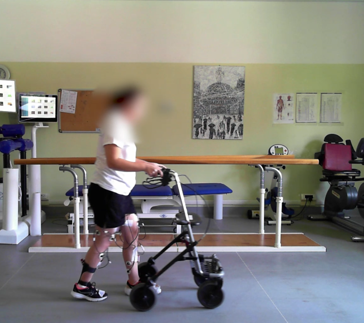Paralizzata dopo un incidente sportivo, una 32enne è tornata a camminare dopo l'impianto di un neurostimolatore midollare al San Raffaele di Milano 