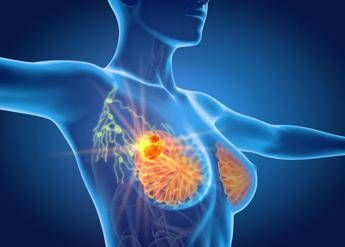 Breast cancer: -25% recurrence risk with ribociclib after surgery