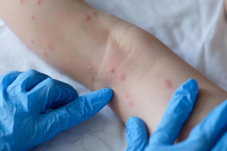 Tornano Open day dermatite atopica in 40 centri, campagna Sidemast