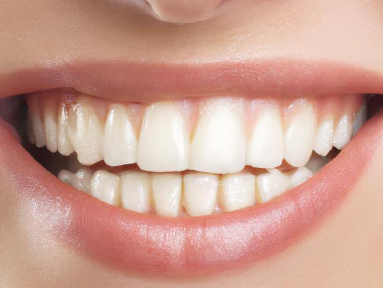 Sorriso 'social' perfetto e subito, è boom per le faccette sui denti anche a 14 anni