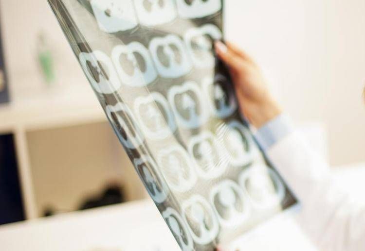 Ainmo, 'nuova terapia per neuromielite ottica cambia qualità vita pazienti'