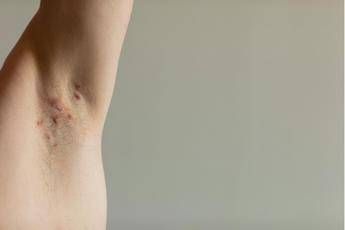 Ucb, buoni risultati monoclonale per idrosadenite suppurativa