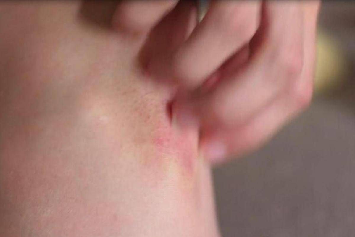 Dermatologia, UCB Pharma mette la psoriasi fuori gioco